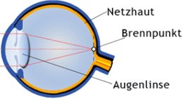 Fehlsichtigkeit -