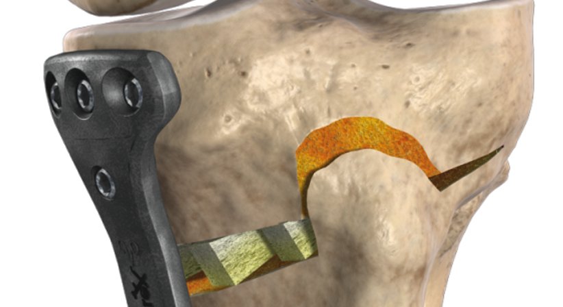 Arthrose - Dr. Jürgen Barthofer - Unfallchirurg Linz 4020
