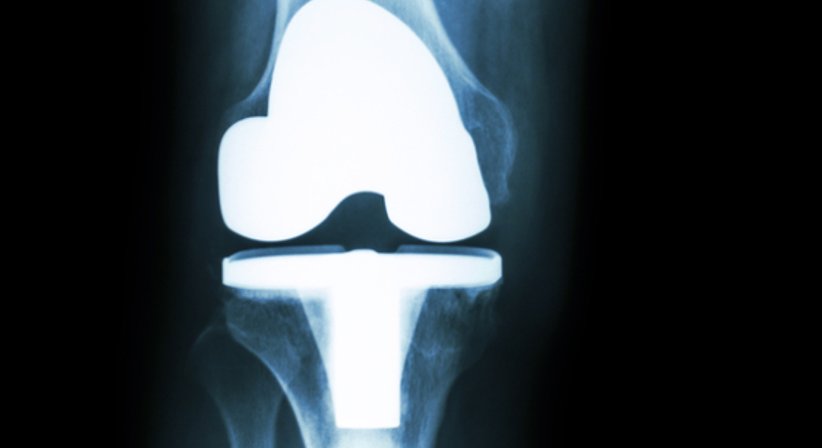 Knieprothese - Dr. Jürgen Barthofer - Unfallchirurg Linz 4020