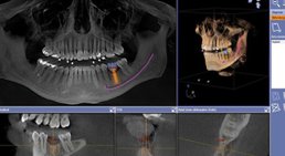 Implantologie 3D -