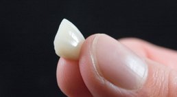 Veneers -