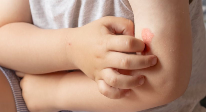 Allergie-Behandlung - Dr. Marion Kalb - Kinderärztin Wien 1010