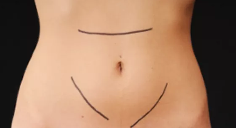 Fettabsaugung / Liposuktion - Univ.Doz. Dr. Artur Worseg - Plastischer Chirurg Wien 1190