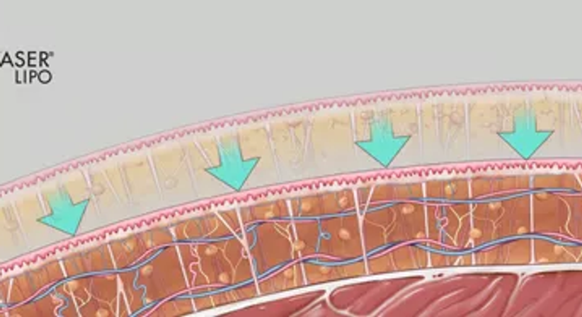 Fettabsaugung / Liposuktion - Univ.Doz. Dr. Artur Worseg - Plastischer Chirurg Wien 1190