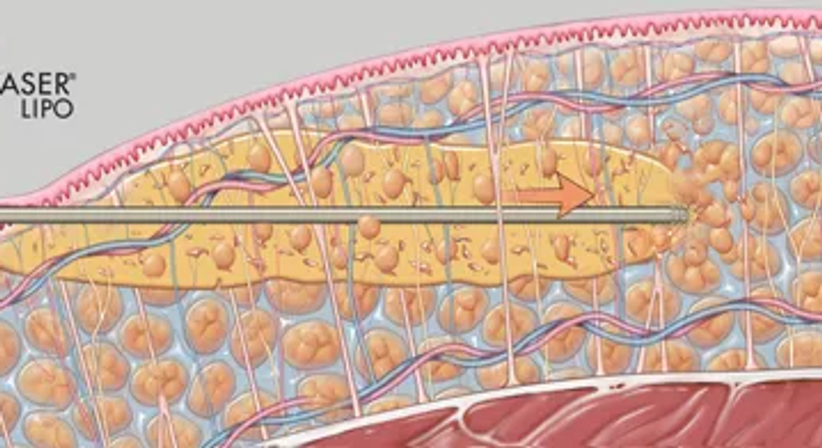 Fettabsaugung / Liposuktion - Univ.Doz. Dr. Artur Worseg - Plastischer Chirurg Wien 1190