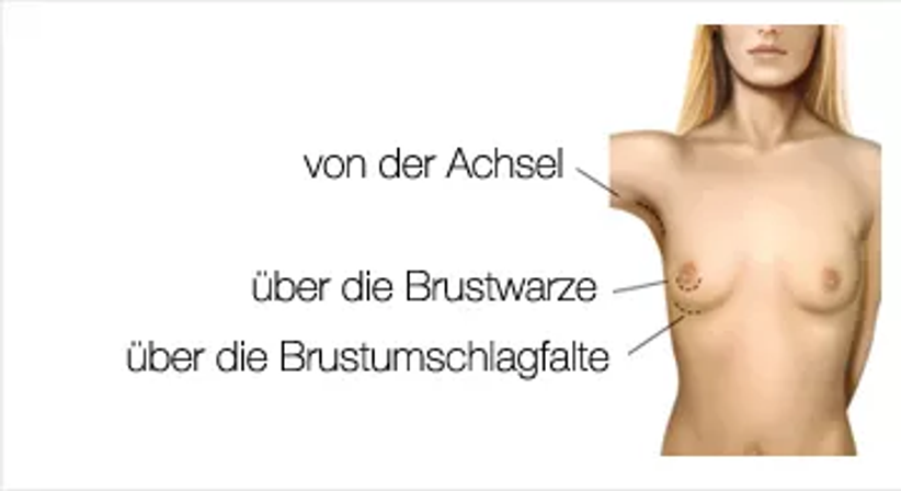 Brustvergrösserung - Univ.Doz. Dr. Artur Worseg - Plastischer Chirurg Wien 1190