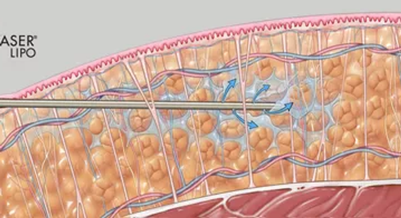 Fettabsaugung / Liposuktion - Univ.Doz. Dr. Artur Worseg - Plastischer Chirurg Wien 1190