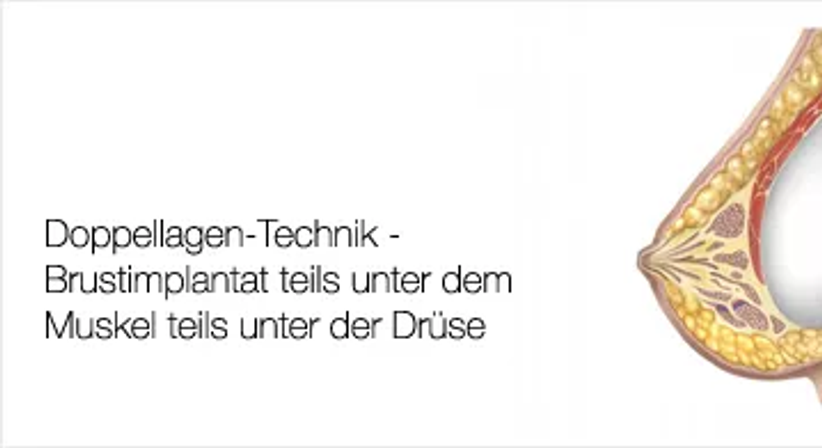 Bruststraffung - Univ.Doz. Dr. Artur Worseg - Plastischer Chirurg Wien 1190