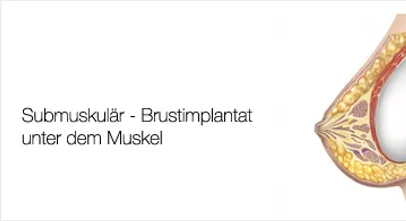 Bruststraffung - Univ.Doz. Dr. Artur Worseg - Plastischer Chirurg Wien 1190
