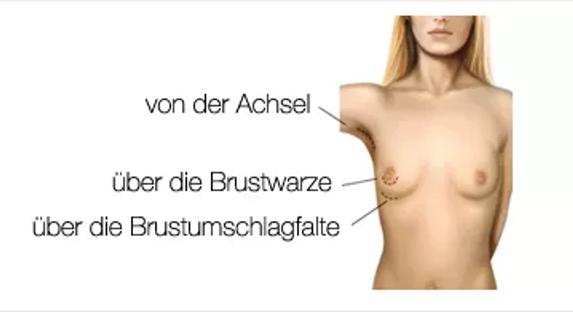 Bruststraffung - Univ.Doz. Dr. Artur Worseg - Plastischer Chirurg Wien 1190