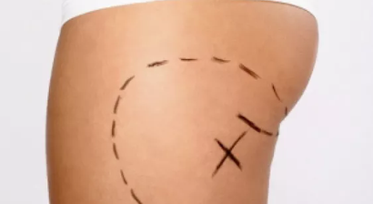 Fettabsaugung / Liposuktion