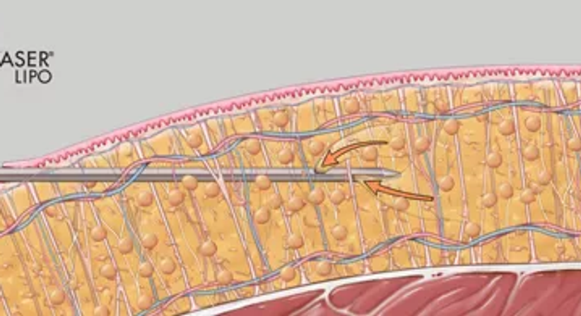 Fettabsaugung / Liposuktion - Univ.Doz. Dr. Artur Worseg - Plastischer Chirurg Wien 1190