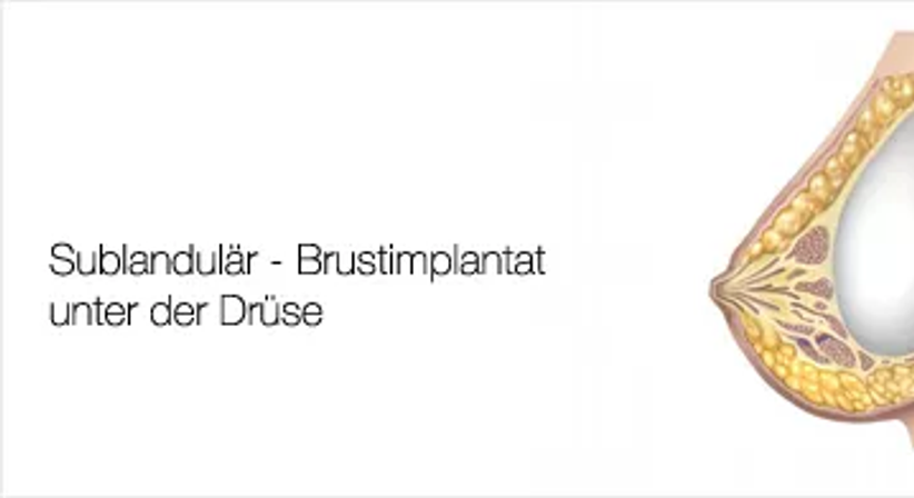 Brustvergrösserung - Univ.Doz. Dr. Artur Worseg - Plastischer Chirurg Wien 1190