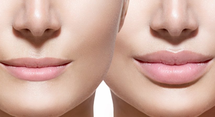Botox und Hyaluronsäure - Priv.-Doz. Dr. Johannes Matiasek - Plastischer Chirurg Wien 1010