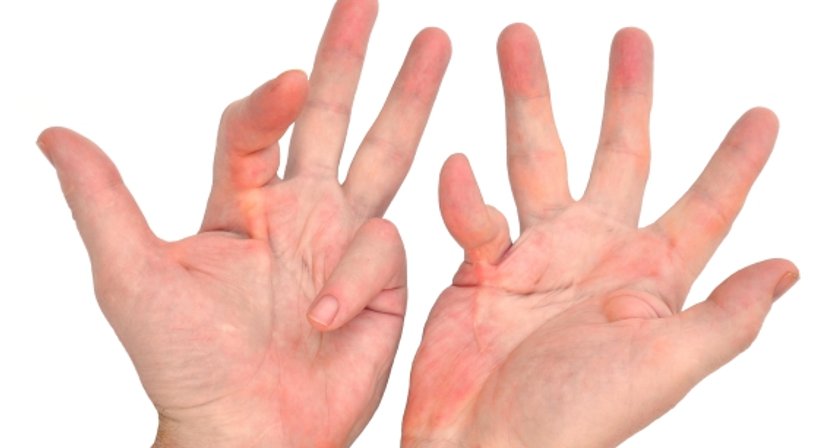Karpaltunnelsyndrom / Handchirurgie - Priv.-Doz. Dr. Johannes Matiasek - Plastischer Chirurg Wien 1010