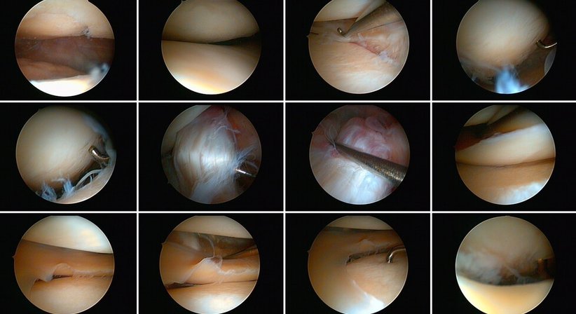 Arthrose-Behandlung - Dr. Ulrich Müller - Orthopäde Wien 1220