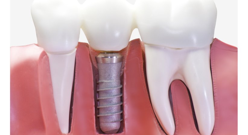 Chirurgie - Dr.med.dent. Sonja Wolf - Zahnärztin Wien 1210