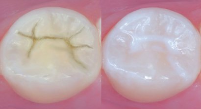 Fissurenversiegelung