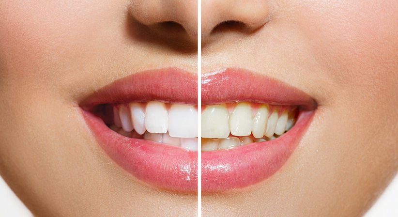 Laserbleaching - Dr.med.dent. Sonja Wolf - Zahnärztin Wien 1210