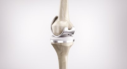 Knieprothese / Teilprothese und Total-Endoprothese (Knie-TEP)