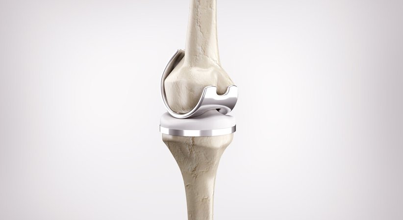 Knieprothese / Teilprothese und Total-Endoprothese (Knie-TEP) - OA Dr. Christopher Godwin-Toby - Orthopäde Gablitz 3003