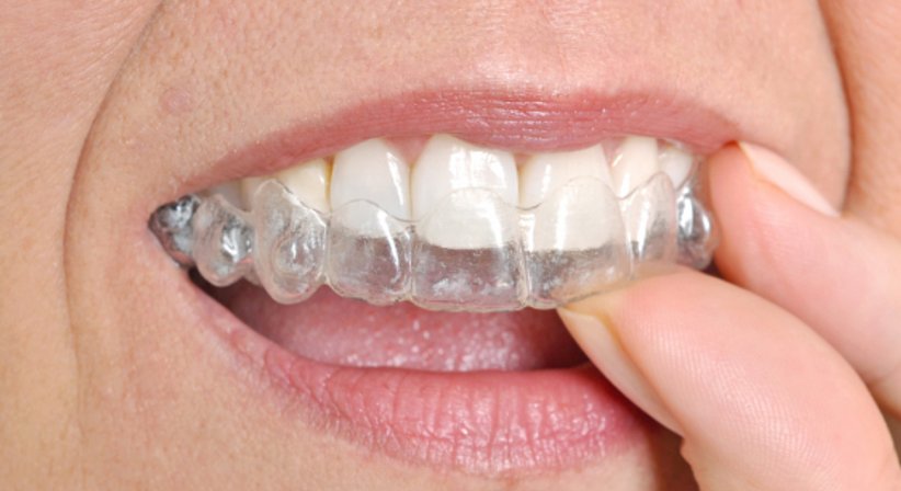 Ästhetische Schienentherapie - Dr.med.dent. Natascha Witzmann - Zahnärztin Wien 1020