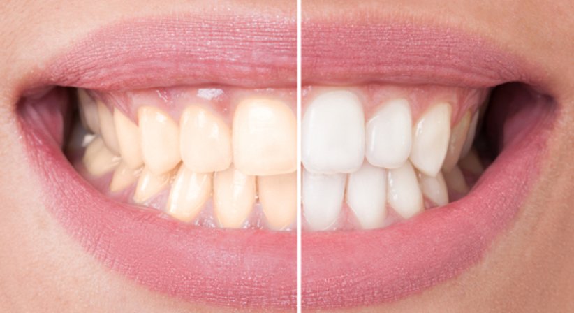 Bleaching - Dr.med.dent. Natascha Witzmann - Zahnärztin Wien 1020