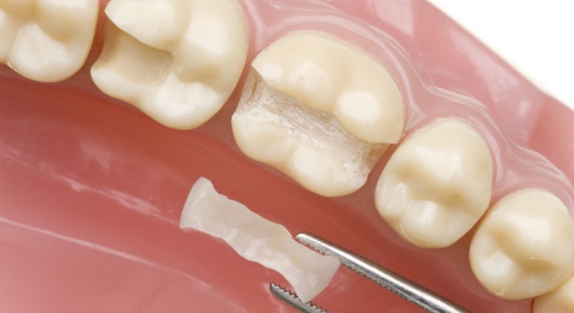 Inlays / Onlays - Dr.med.dent. Natascha Witzmann - Zahnärztin Wien 1020