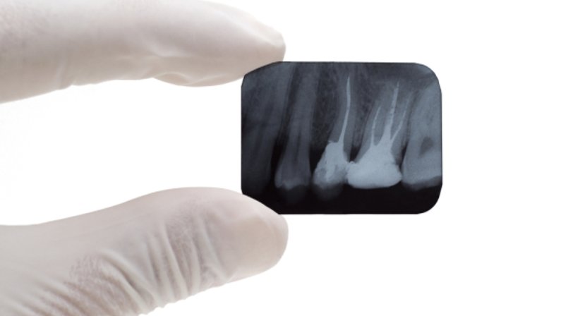 Wurzelbehandlung - Dr.med.dent. Natascha Witzmann - Zahnärztin Wien 1020