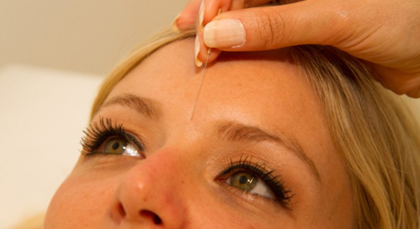 Akupunktur - Dr. Azita Schlarp-Ahmadzadeh - Praktische Ärztin Korneuburg 2100