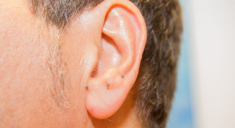 Akupunktur - Dr. Azita Schlarp-Ahmadzadeh - Praktische Ärztin Korneuburg 2100