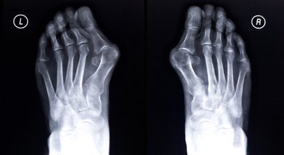 Hallux valgus