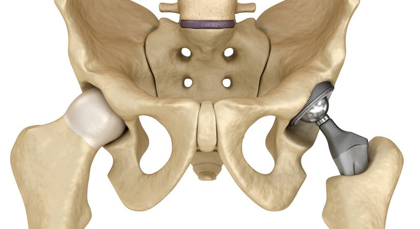 Hüftprothese - Dr. Robert Legenstein, MSc - Orthopäde Klosterneuburg 3400