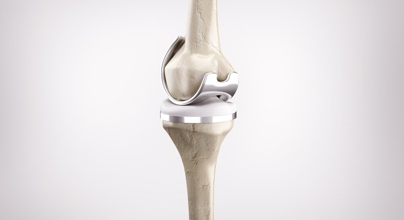 Knieprothese - Dr. Robert Legenstein, MSc - Orthopäde Klosterneuburg 3400