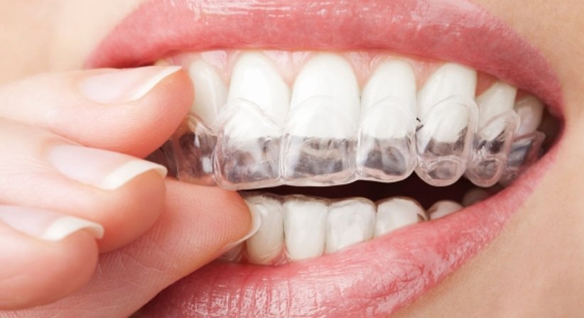 Invisalign - DDr. A.Edmond Selli - Zahnarzt Wien 1090