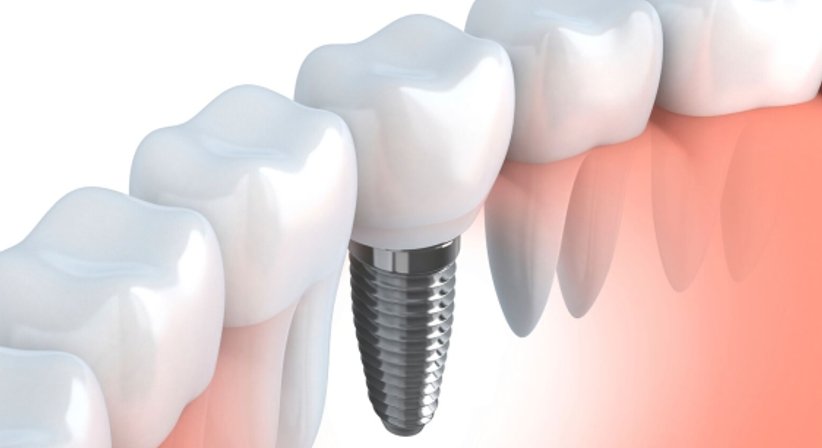 Zahnimplantate - DDr. A.Edmond Selli - Zahnarzt Wien 1090