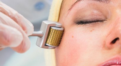 Microneedling