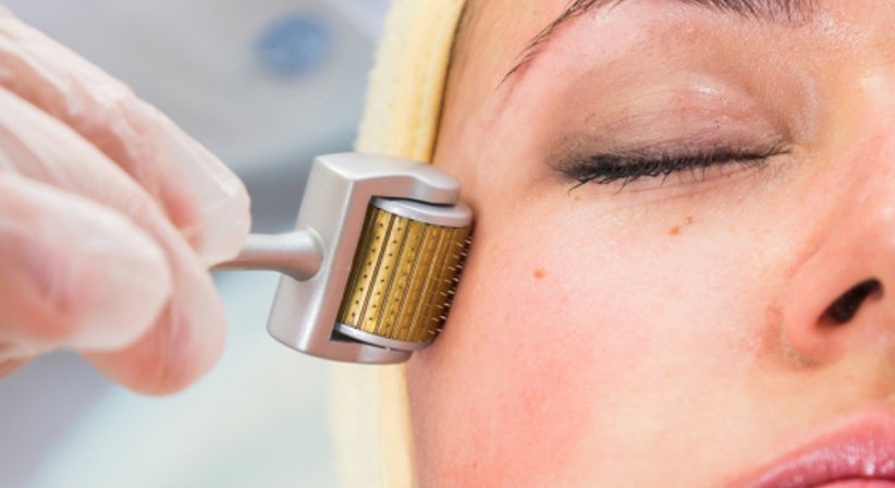 Microneedling - Dr. Miodrag Ognjanovic - HNO-Arzt Wien 1070