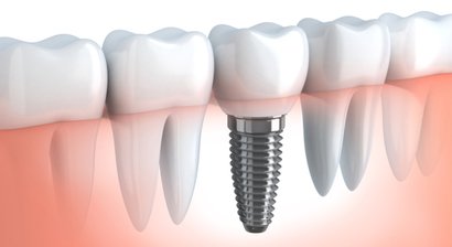 Zahnimplantate