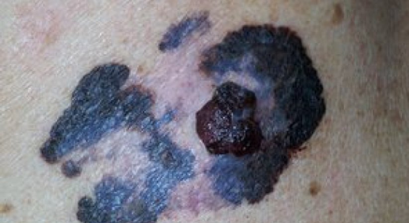 Hautkrebs - Dr. Katja Schindler - Hautärztin Wien 1010