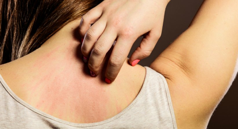 Hautnebenwirkungen von Krebstherapien - Dr. Katja Schindler - Hautärztin Wien 1010