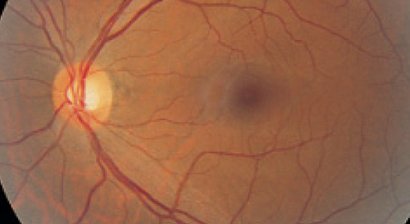 Laserbehandlung der Netzhaut