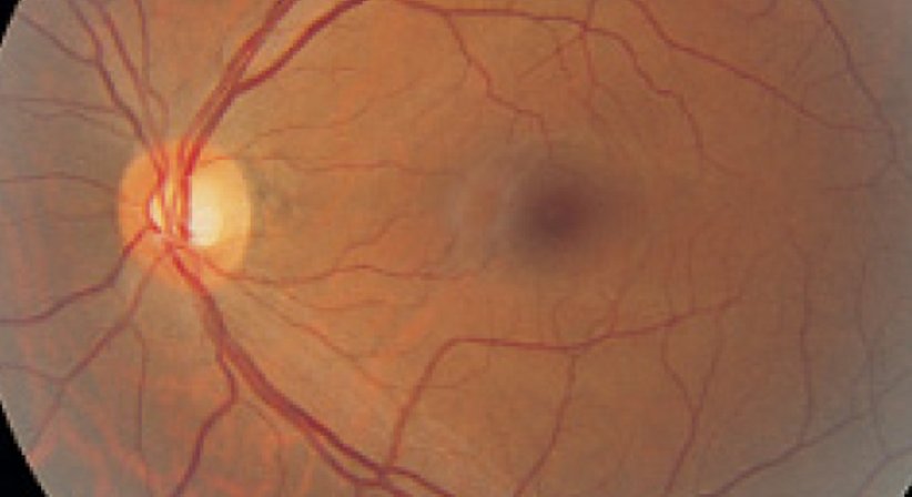 Laserbehandlung der Netzhaut - Univ.-Prof. Dr. Mathias Zirm - Augenarzt Innsbruck 6020