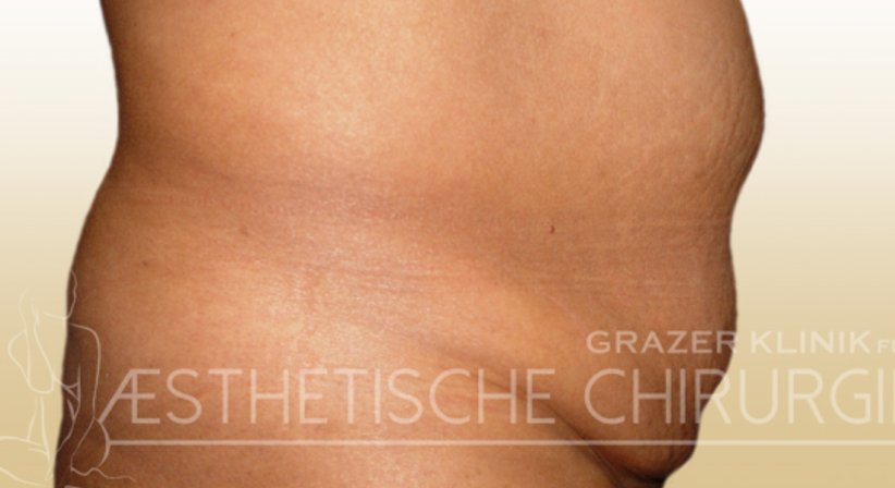 Bauchdeckenstraffung - Dr. Gunther Arco - Allgemeinchirurg Graz 8055