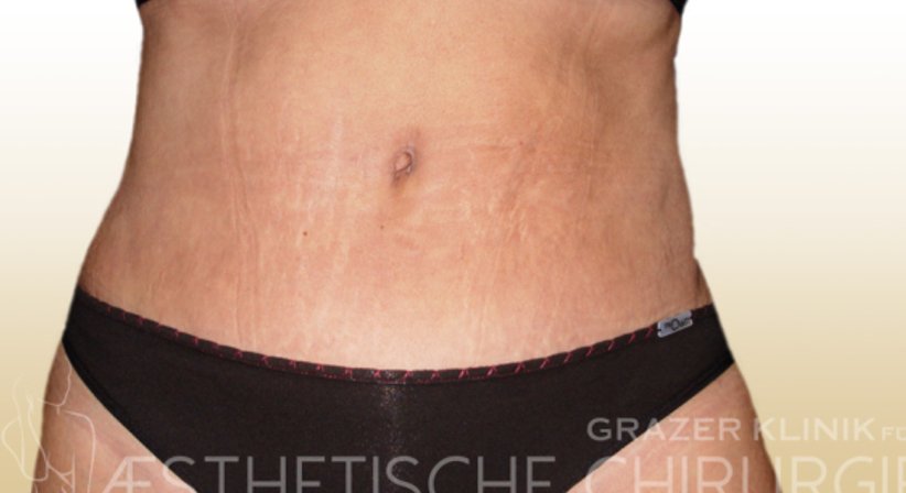 Bauchdeckenstraffung - Dr. Gunther Arco - Allgemeinchirurg Graz 8055