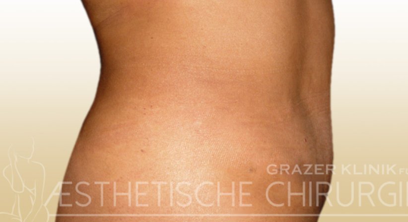 Bauchdeckenstraffung - Dr. Gunther Arco - Allgemeinchirurg Graz 8055