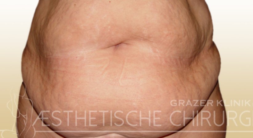 Bauchdeckenstraffung - Dr. Gunther Arco - Allgemeinchirurg Graz 8055