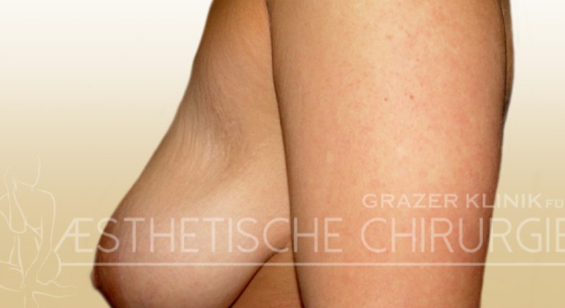 Bruststraffung - Dr. Gunther Arco - Allgemeinchirurg Graz 8055