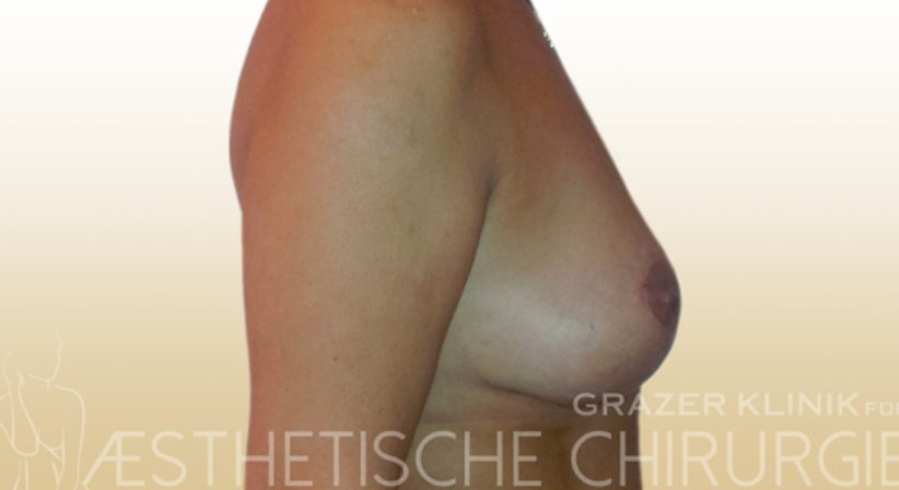 Bruststraffung - Dr. Gunther Arco - Allgemeinchirurg Graz 8055