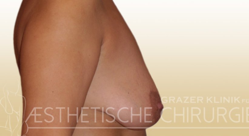 Bruststraffung - Dr. Gunther Arco - Allgemeinchirurg Graz 8055